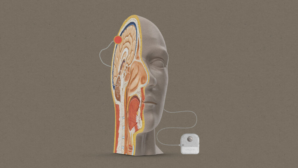 Apple-Brain-Computer Interface-Neuralink-Synchron-Stentrode-Non-Invasive Technology-Mind Control iPhone