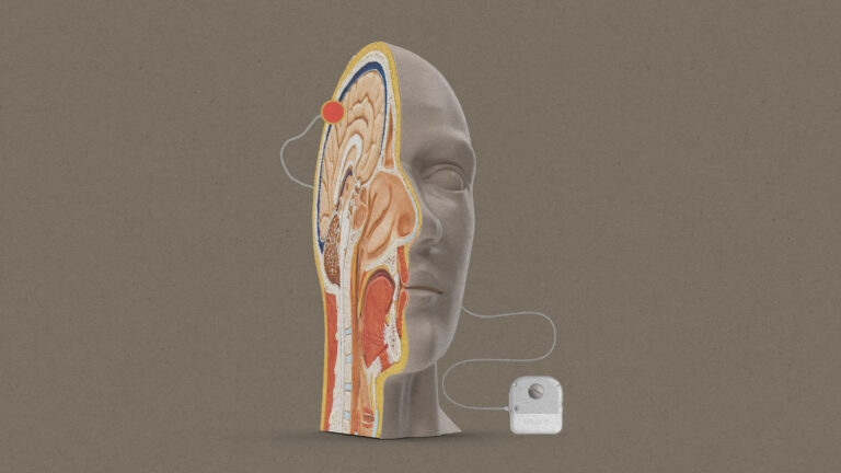 Apple-Brain-Computer Interface-Neuralink-Synchron-Stentrode-Non-Invasive Technology-Mind Control iPhone