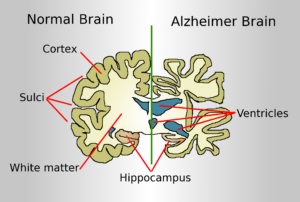 Dementia-China-Alzheimer's disease-global comparison-public health-aging population-lifestyle changes