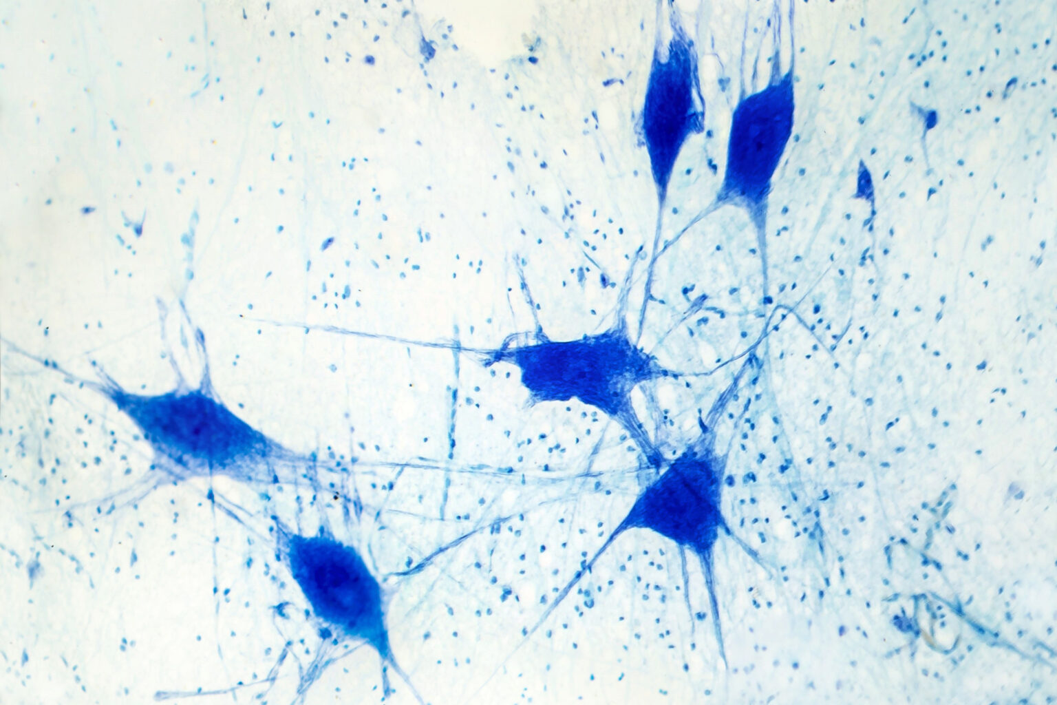 alzheimers-herpes simplex virus-HSV-1-antiviral treatment-vaccine-dementia