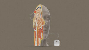 Apple-Brain-Computer Interface-Neuralink-Synchron-Stentrode-Non-Invasive Technology-Mind Control iPhone