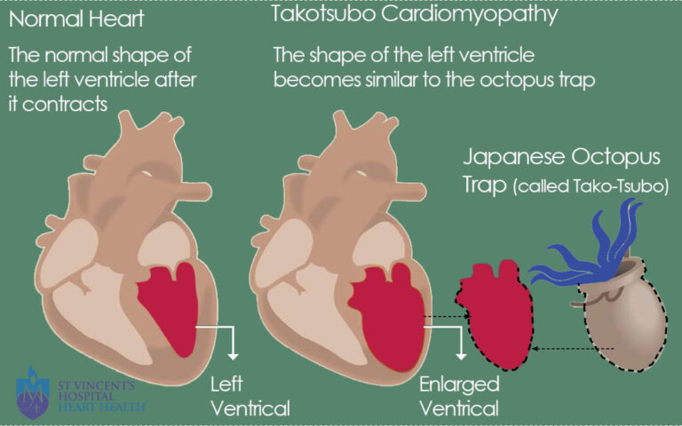 broken heart syndrome-takotsubo cardiomyopathy-stress-induced cardiomyopathy-emotional stress-gender health risks